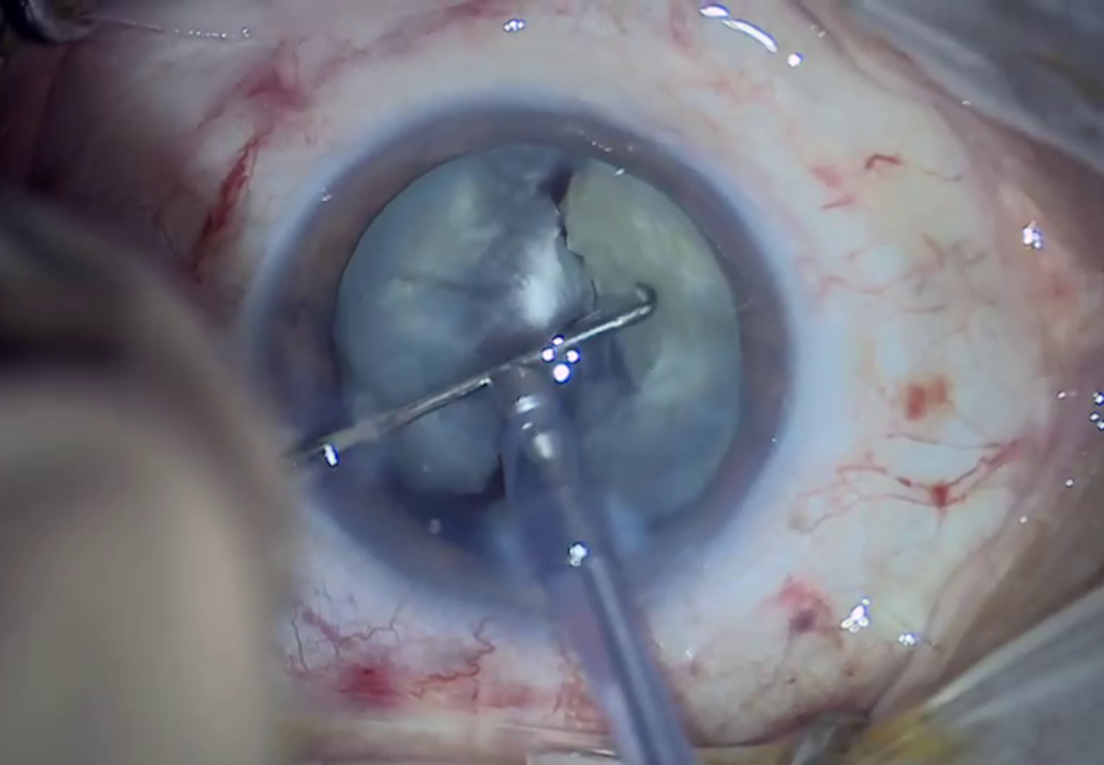 Video | New EVA Trocar Cannula (animation) .C. Dutch Ophthalmic  Research Center |
