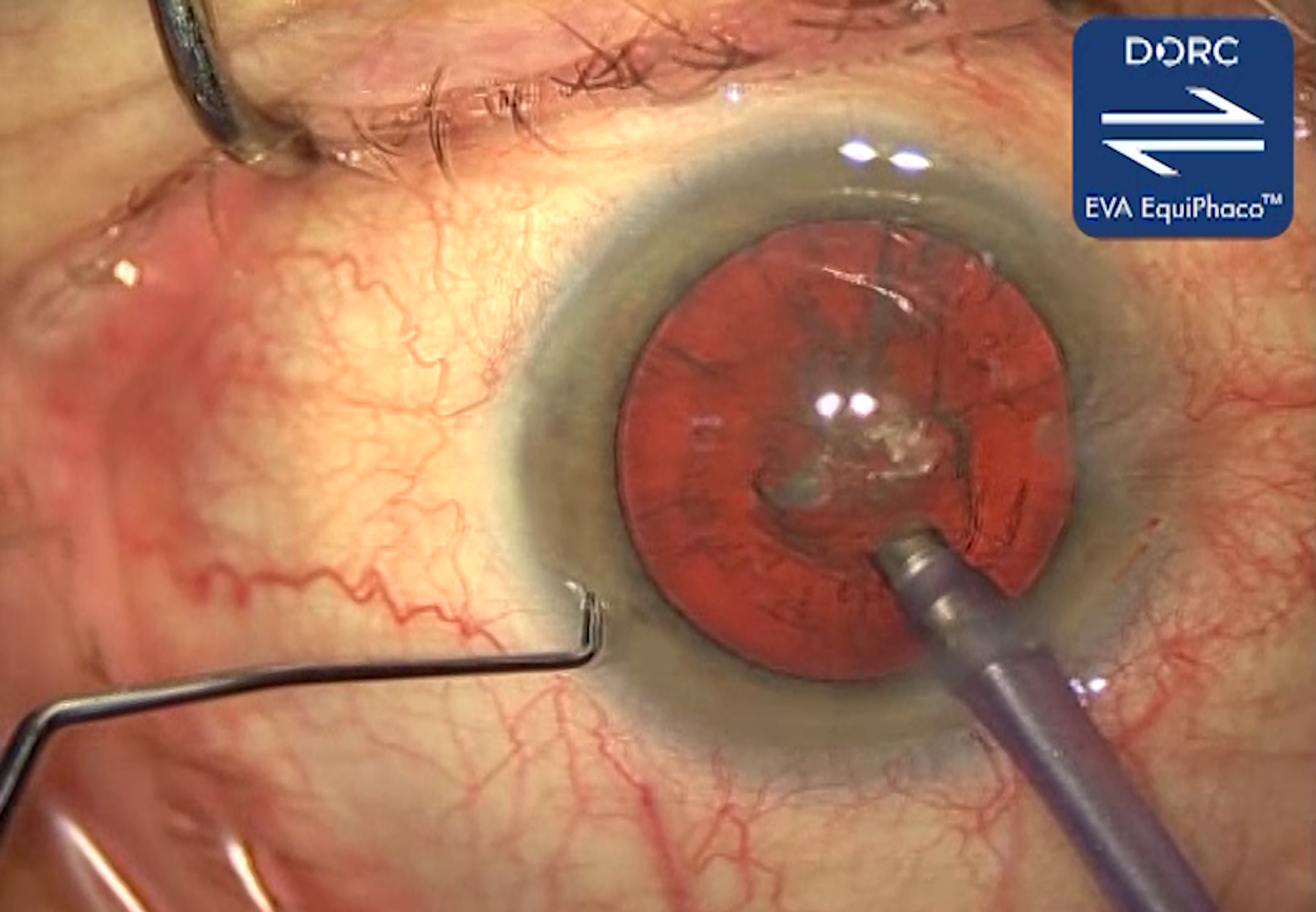 Hard cataract: EVA EquiPhaco™ 1.8 mm 30° straight flared needle